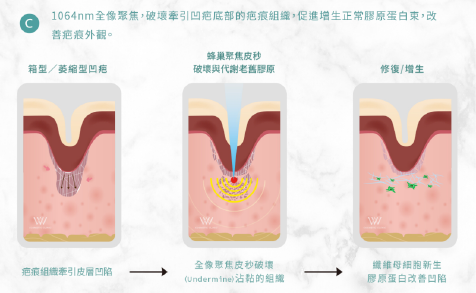 1064nm蜂巢皮秒雷射，改善毛孔凹疤原理