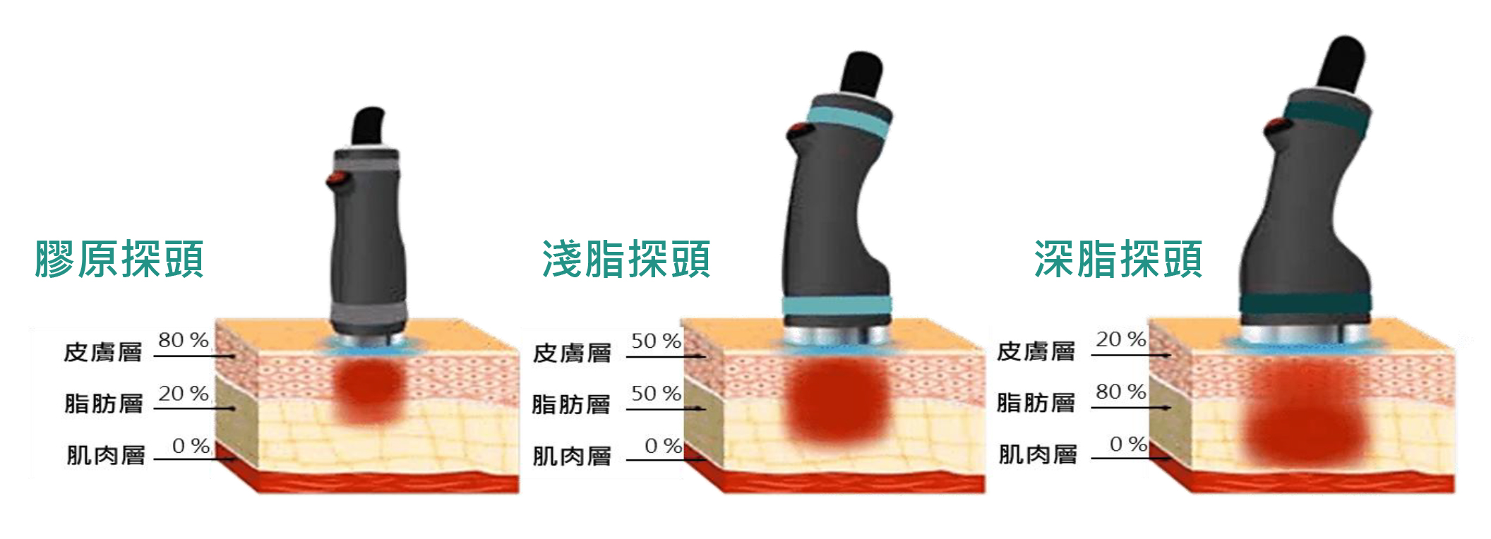 W頂尖 ONDA 三種探頭