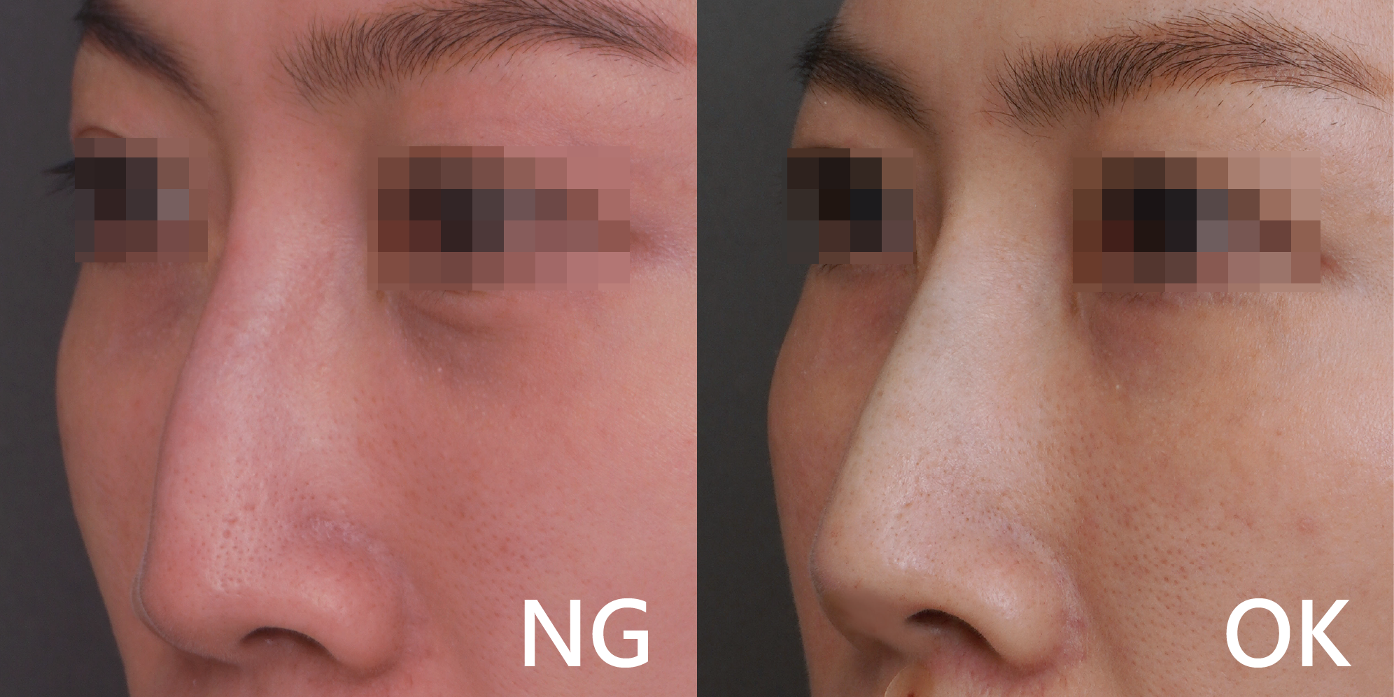 W頂尖鼻線雕案例照1