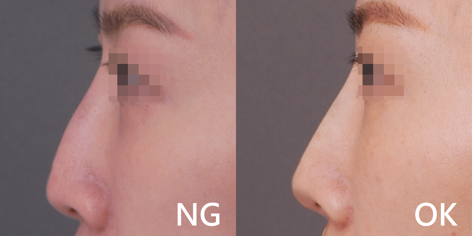 W頂尖鼻線雕案例照2