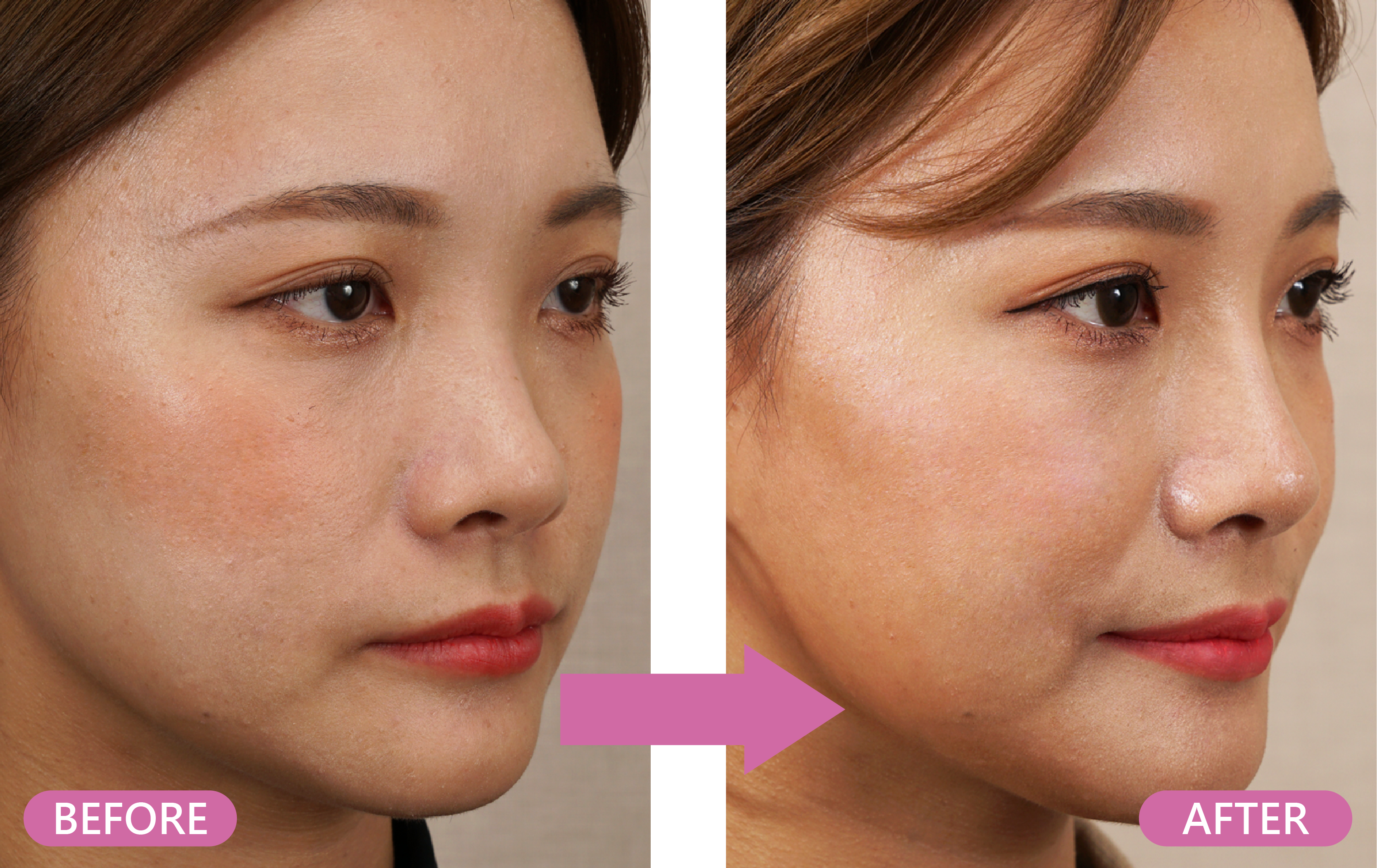 案例 IVY 前後對比照