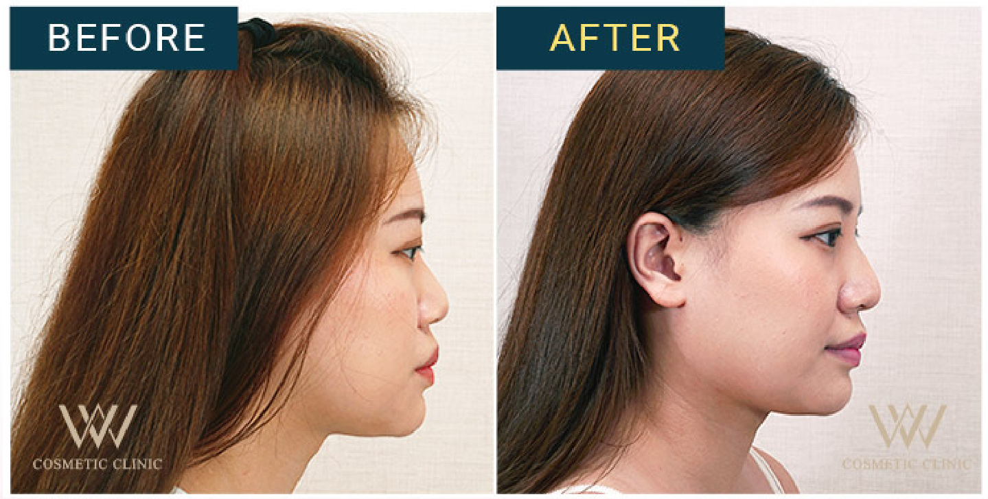 埋線隆鼻案例10