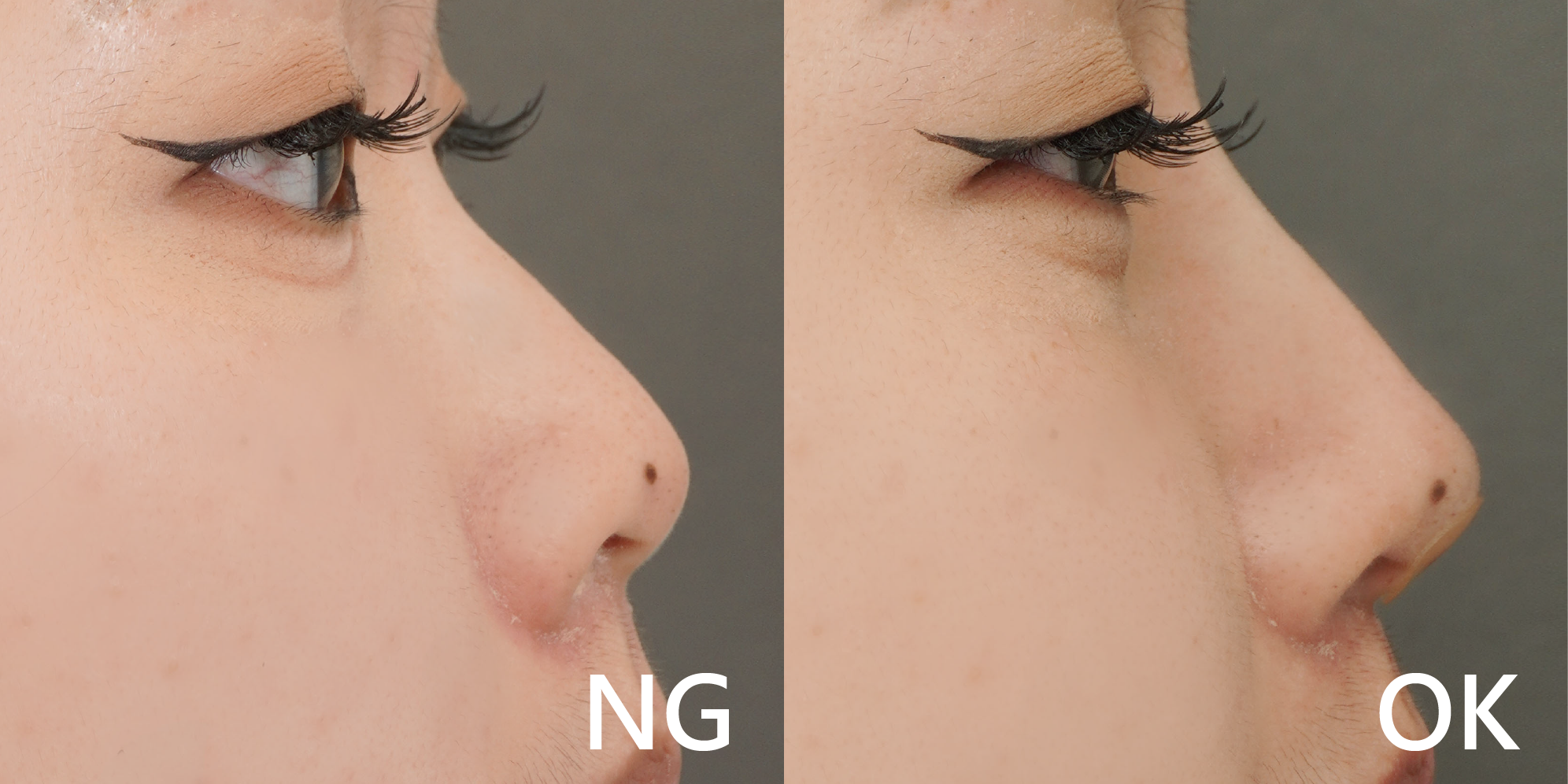 W頂尖鼻線雕案例照3